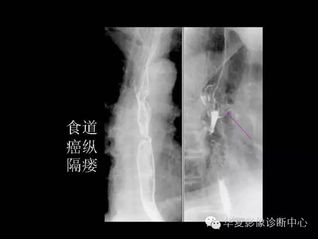 【PPT】食道常见疾病影像诊断