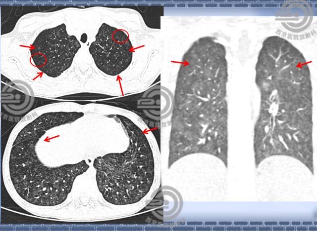 【病例】肺静脉闭塞性疾病1例CT影像表现