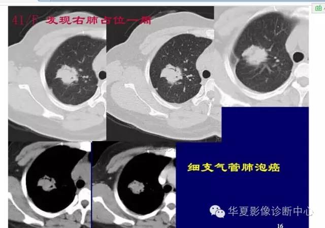 磨玻璃结节良恶性影像分析策略
