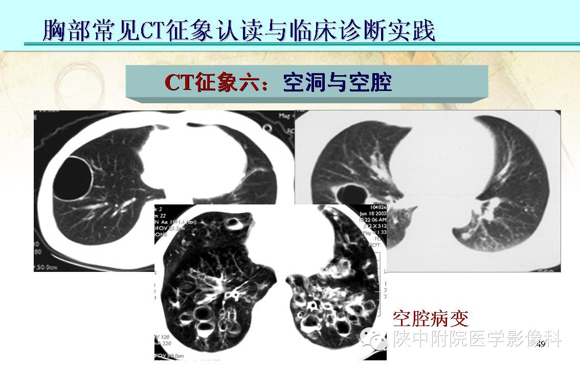 【PPT】胸部常见疾病的CT基本征象