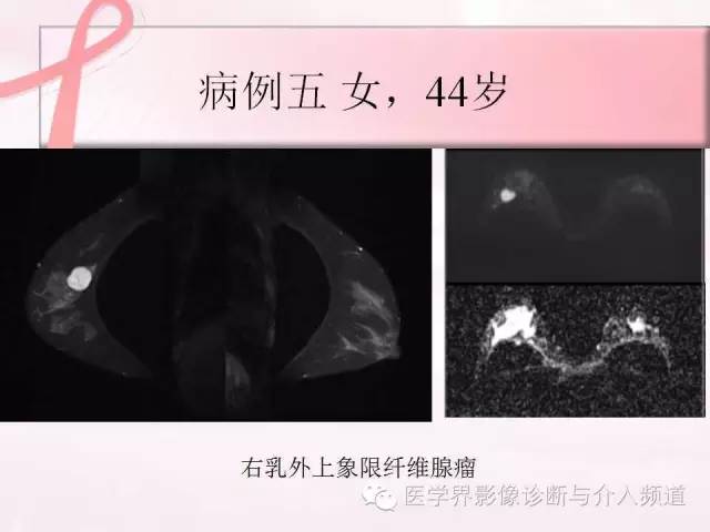 【PPT】隆乳术及其MRI表现