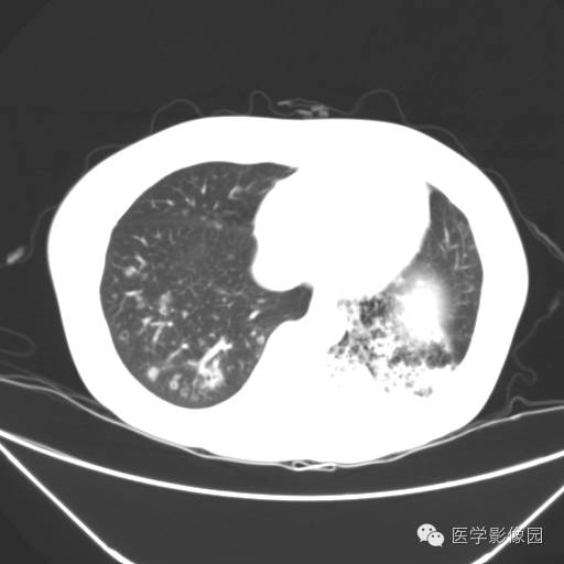 【病例】肺叶实变性支气管肺泡癌1例CT影像表现