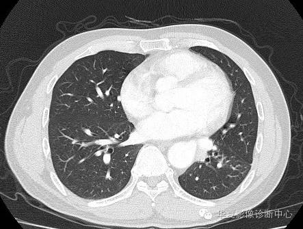 【病例】异常体动脉供血左肺下叶1例CT影像表现
