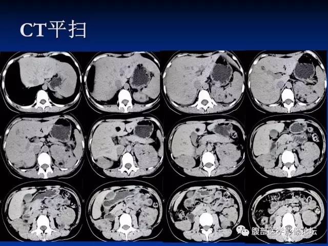 【病例】结节性硬化、肝肾血管平滑肌脂肪瘤、肺淋巴管肌瘤病一例CT