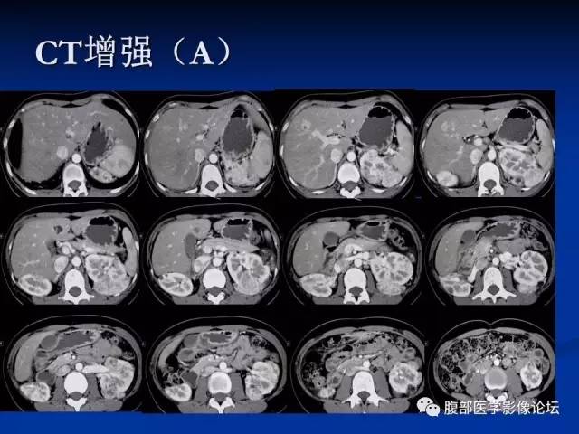 【病例】结节性硬化、肝肾血管平滑肌脂肪瘤、肺淋巴管肌瘤病一例CT