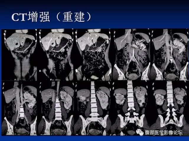 【病例】结节性硬化、肝肾血管平滑肌脂肪瘤、肺淋巴管肌瘤病一例CT