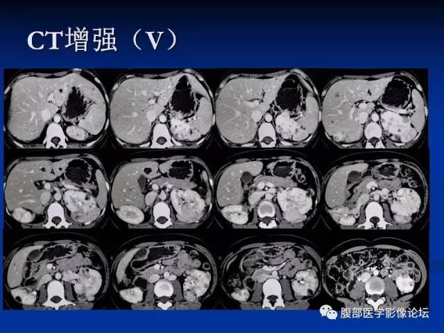 【病例】结节性硬化、肝肾血管平滑肌脂肪瘤、肺淋巴管肌瘤病一例CT