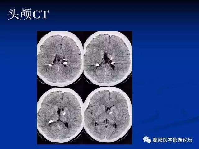 【病例】结节性硬化、肝肾血管平滑肌脂肪瘤、肺淋巴管肌瘤病一例CT