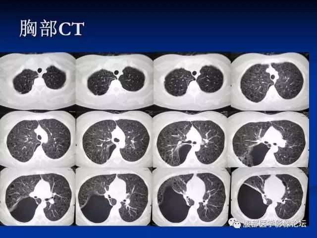 【病例】结节性硬化、肝肾血管平滑肌脂肪瘤、肺淋巴管肌瘤病一例CT