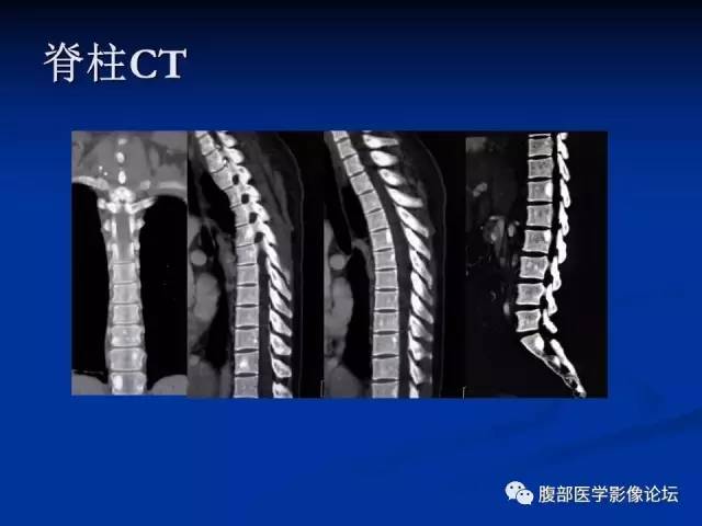 【病例】结节性硬化、肝肾血管平滑肌脂肪瘤、肺淋巴管肌瘤病一例CT