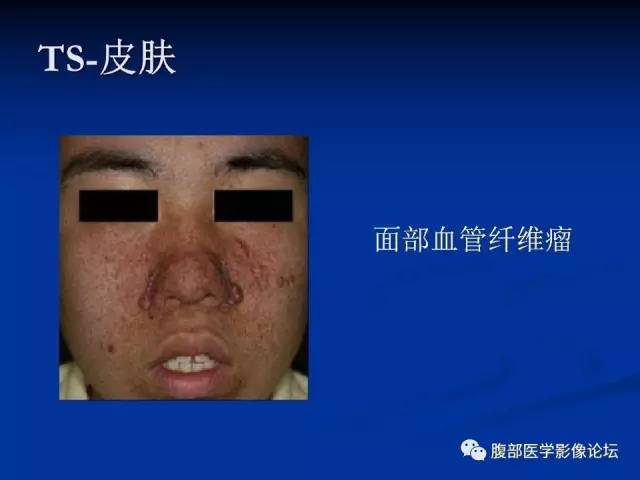 【病例】结节性硬化、肝肾血管平滑肌脂肪瘤、肺淋巴管肌瘤病一例CT