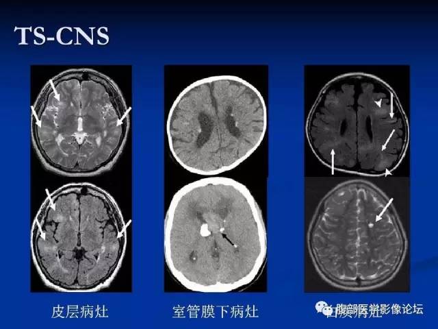 【病例】结节性硬化、肝肾血管平滑肌脂肪瘤、肺淋巴管肌瘤病一例CT