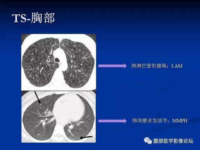 【病例】结节性硬化、肝肾血管平滑肌脂肪瘤、肺淋巴管肌瘤病一例CT