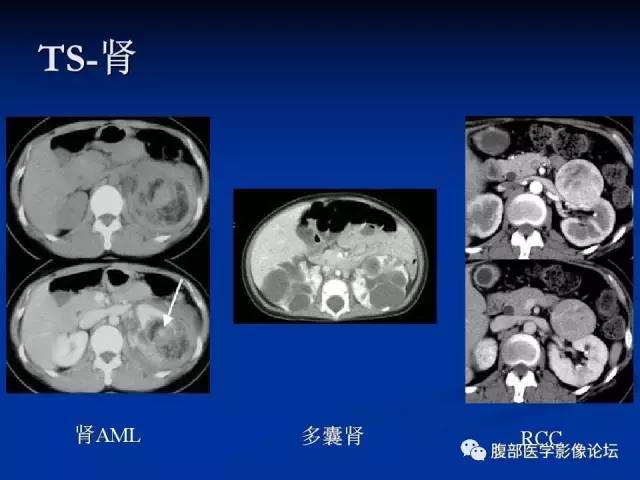 【病例】结节性硬化、肝肾血管平滑肌脂肪瘤、肺淋巴管肌瘤病一例CT