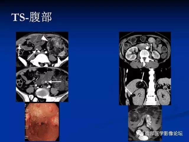 【病例】结节性硬化、肝肾血管平滑肌脂肪瘤、肺淋巴管肌瘤病一例CT