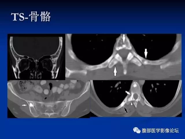 【病例】结节性硬化、肝肾血管平滑肌脂肪瘤、肺淋巴管肌瘤病一例CT