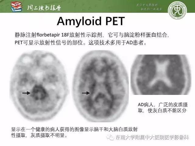 【PPT】帕金森综合征的结构与功能成像