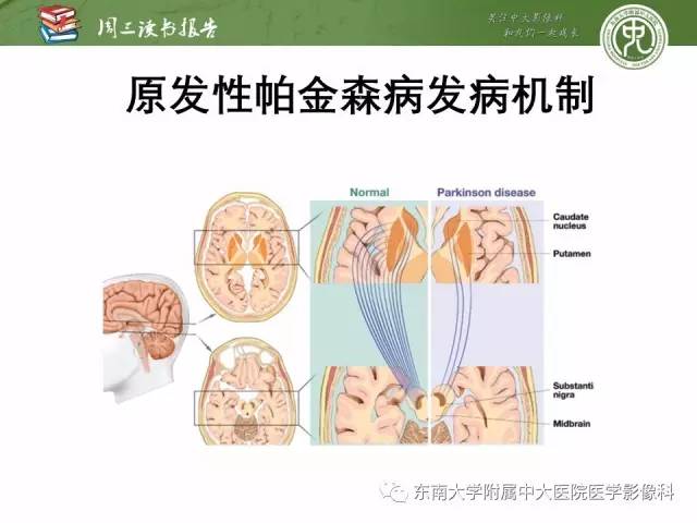 【PPT】帕金森综合征的结构与功能成像