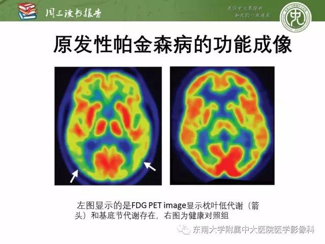 【PPT】帕金森综合征的结构与功能成像