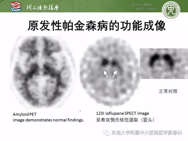 【PPT】帕金森综合征的结构与功能成像