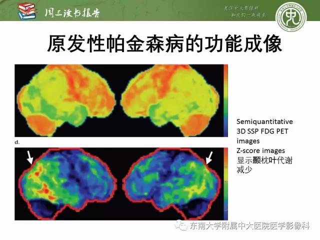 【PPT】帕金森综合征的结构与功能成像