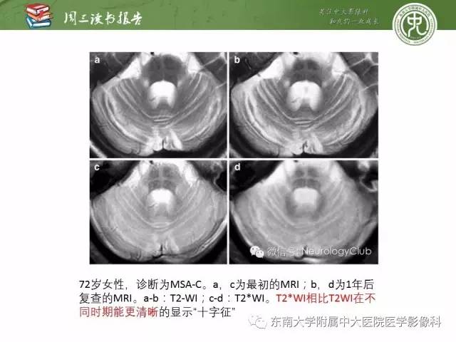 【PPT】帕金森综合征的结构与功能成像
