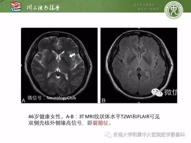【PPT】帕金森综合征的结构与功能成像