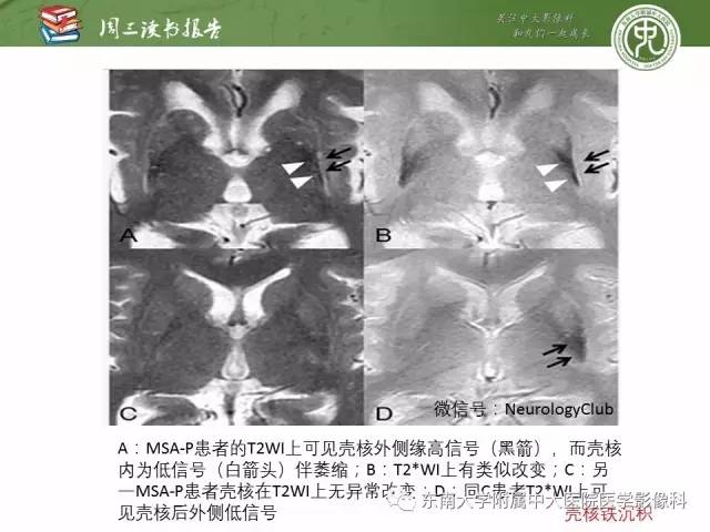 【PPT】帕金森综合征的结构与功能成像