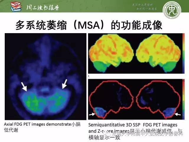 【PPT】帕金森综合征的结构与功能成像