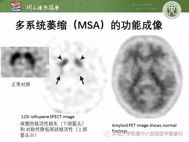 【PPT】帕金森综合征的结构与功能成像