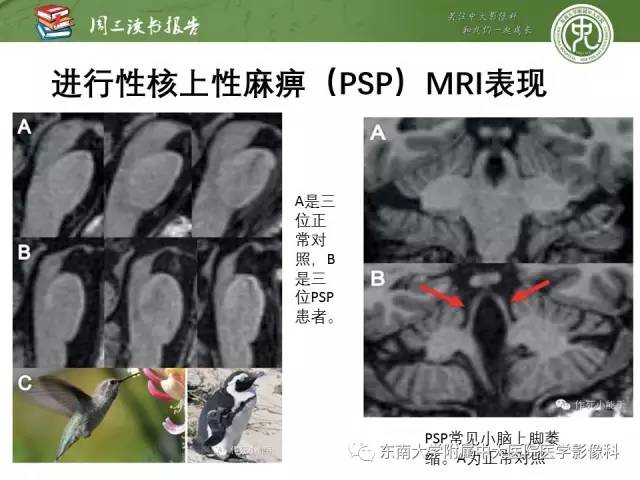 【PPT】帕金森综合征的结构与功能成像