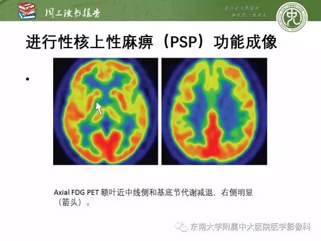 【PPT】帕金森综合征的结构与功能成像