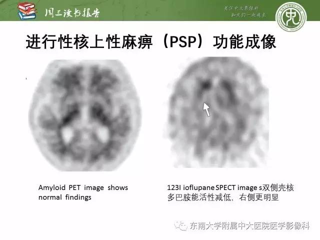 【PPT】帕金森综合征的结构与功能成像