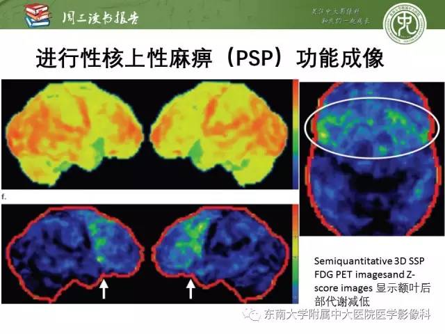 【PPT】帕金森综合征的结构与功能成像