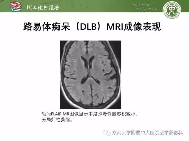 【PPT】帕金森综合征的结构与功能成像