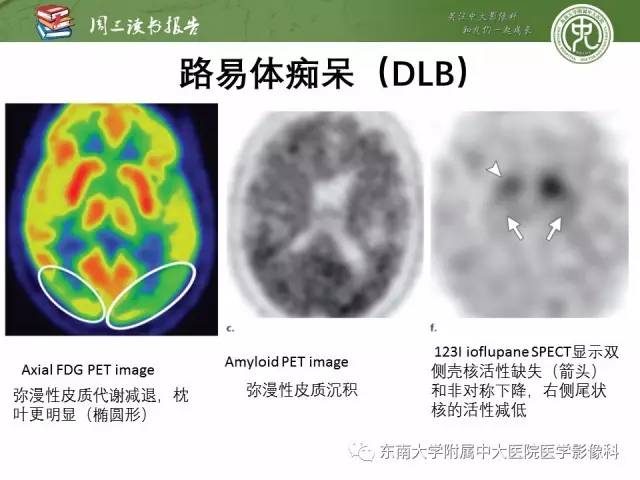【PPT】帕金森综合征的结构与功能成像
