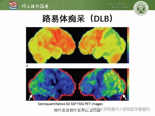 【PPT】帕金森综合征的结构与功能成像