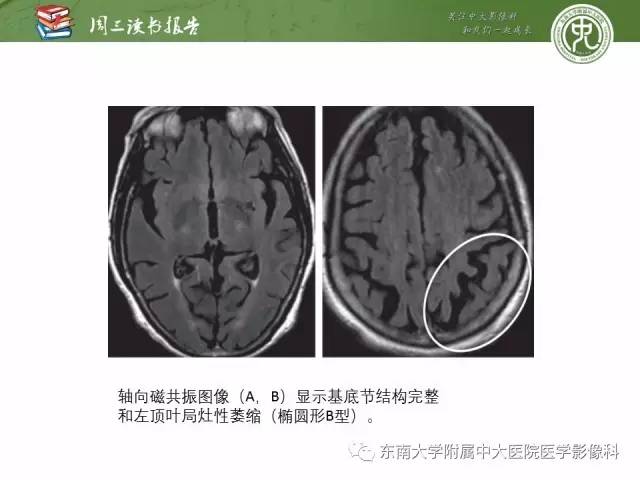 【PPT】帕金森综合征的结构与功能成像