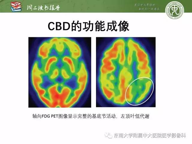 【PPT】帕金森综合征的结构与功能成像