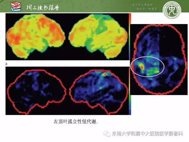 【PPT】帕金森综合征的结构与功能成像
