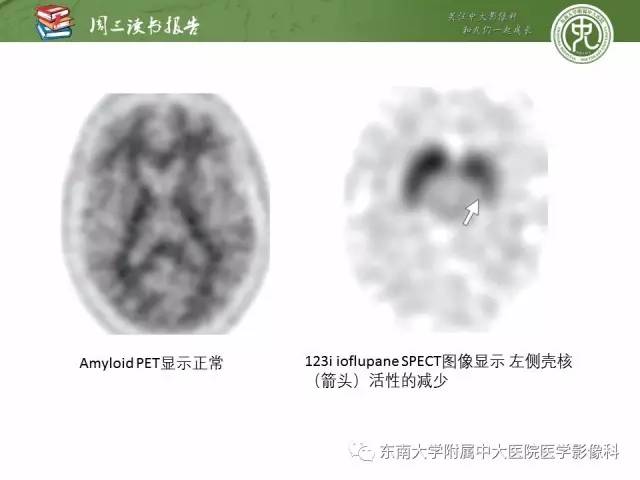【PPT】帕金森综合征的结构与功能成像