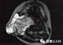【病例】颈部淋巴管瘤1例MR影像表现分析 【病例】颈部淋巴管瘤1例MR影像表现分析