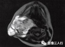 【病例】颈部淋巴管瘤1例MR影像表现分析 【病例】颈部淋巴管瘤1例MR影像表现分析