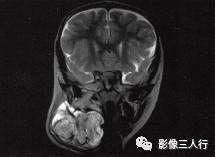 【病例】颈部淋巴管瘤1例MR影像表现分析 【病例】颈部淋巴管瘤1例MR影像表现分析