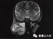 【病例】颈部淋巴管瘤1例MR影像表现分析 【病例】颈部淋巴管瘤1例MR影像表现分析