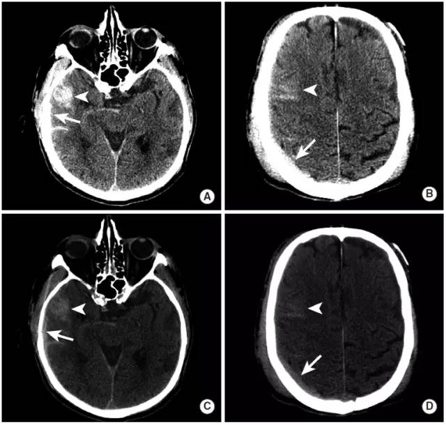 颅内出血影像学表现大全