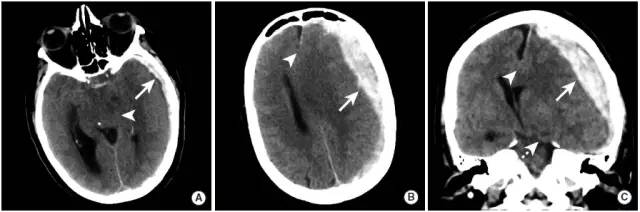 颅内出血影像学表现大全