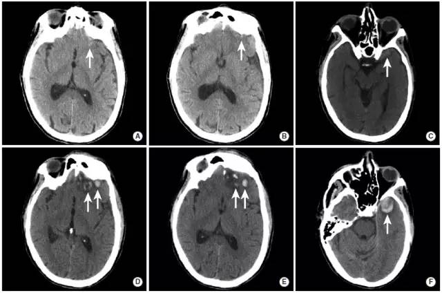 颅内出血影像学表现大全