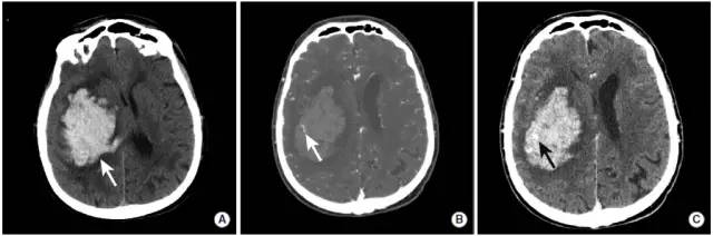 颅内出血影像学表现大全
