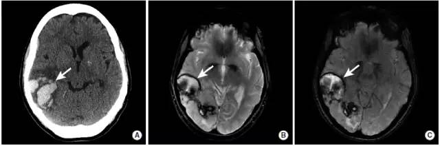 颅内出血影像学表现大全